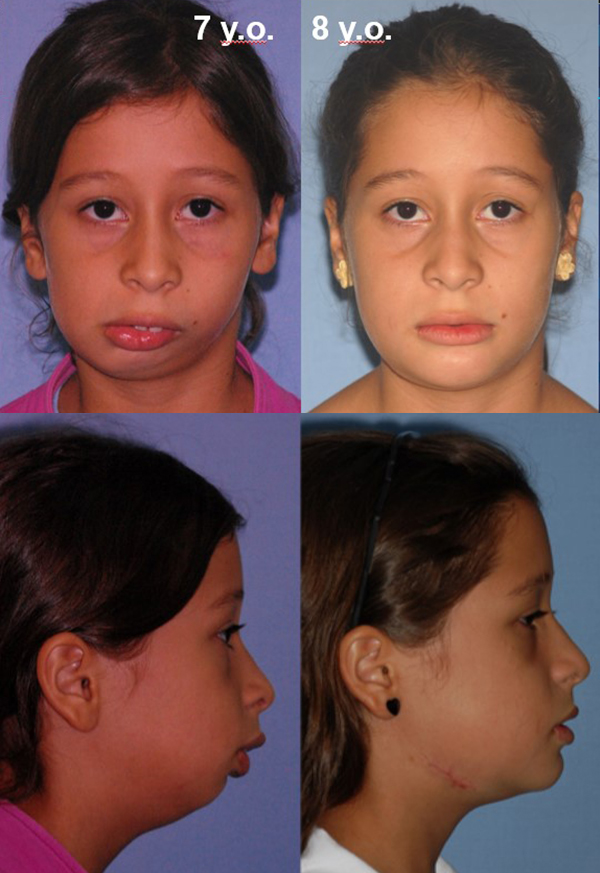 Before and after of a patient's distraction osteogenesis - Dr. Cesar Guerrero - Houston, TX