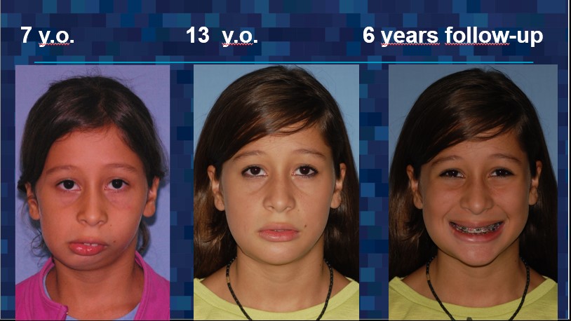 6 years follow up of intraoral maxillary osteogenesis