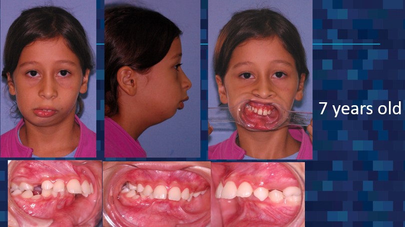 7-year old photo evaluation of teeth and jaw alignment - Dr. Cesar Guerrero - Houston, TX