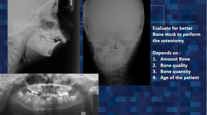 x-ray evaluation for osteotomy - Dr. Cesar Guerrero - Houston, TX