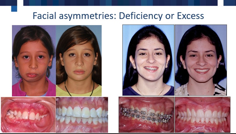 patients with deficient and excess asymmetry