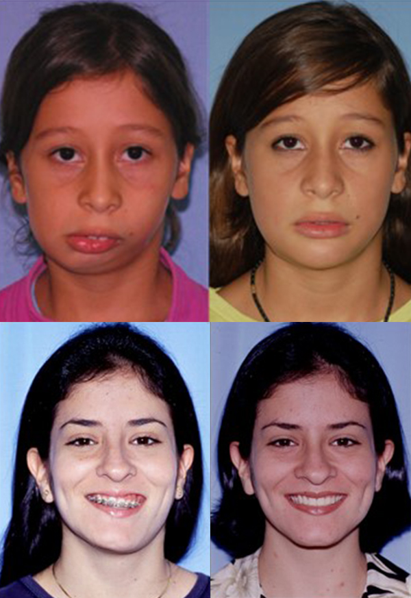 Before and after of patients with facial asymmetry - Dr. Cesar Guerrero - Houston, TX