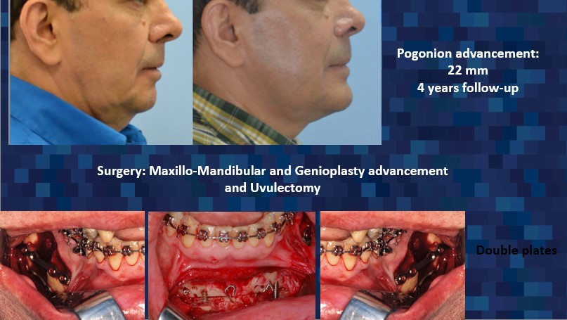 4-year follow-up photo of pogonion advancement and Maxillo-mandibular Advancement and Genioplasty, Uvulectomy surgery photos - Dr. Cesar Guerrero