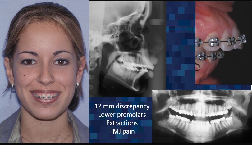 12 mm discrepancy, lower, premolars, extractions, TMJ pain - Dr. Cesar Guerrero