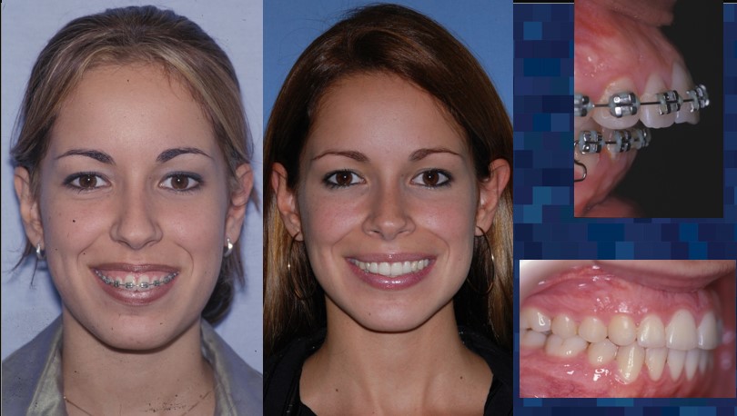 patient wearing braces after orthognathic surgery - Dr. Cesar Guerrero - Houston, Texas
