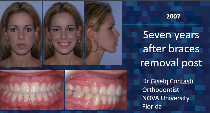 seven years after braces removal - Dr. Cesar Guerrero - Houston, Texas
