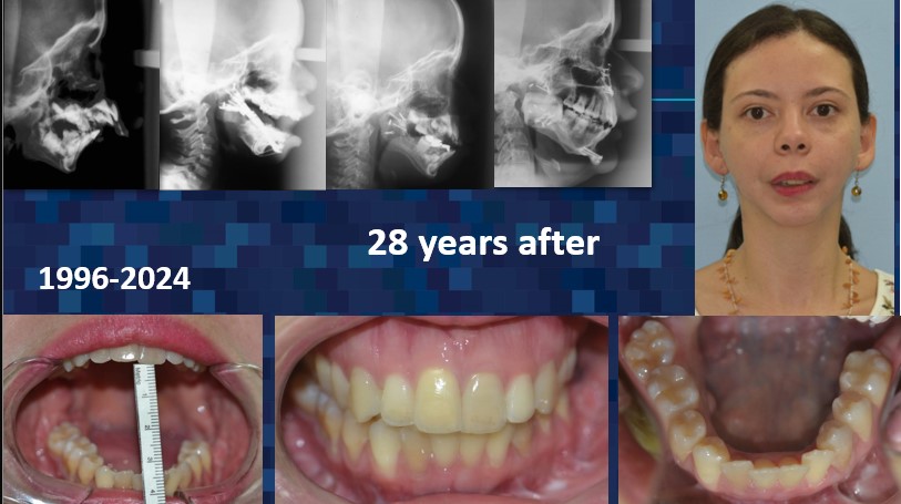 photo of x-rays, teeth, and front facing profile, 28 years after intraoral distraction osteogenesis and TMJ arthroplasty - Dr. Cesar Guerrero