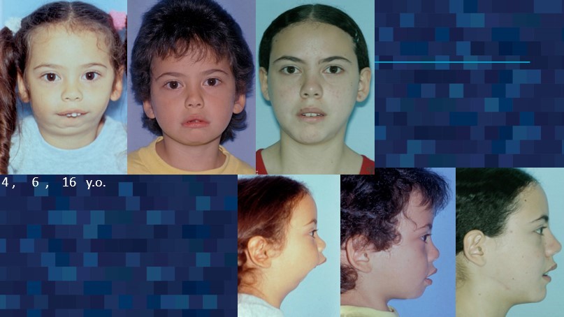 Intraoral Distraction Osteogenesis Progress shown with 4, 6, and 16-year old front and side profile of a girl - Dr. Cesar Guerrero - Houston Oral and Maxillofacial Surgeon