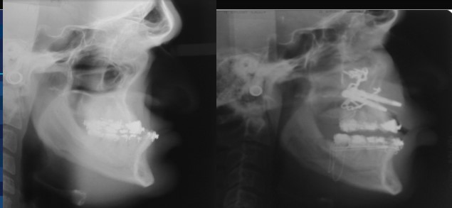 jaw x-ray of patient with sleep apnea/distraction osteogenesis - Dr. Cesar Guerrero - Houston, TX
