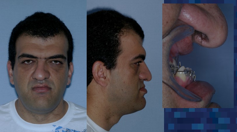 front and side profile of patient with sleep apnea/distraction osteogenesis - Dr. Cesar Guerrero - Houston, TX