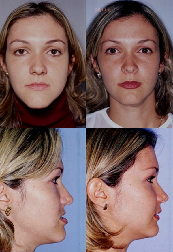 Before and after of a patient's maxillary advancement - Dr. Cesar Guerrero - Houston, TX