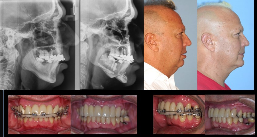 x-ray and images of maxillo-mandibular advancement and genioplasty - Dr. Cesar Guerrero - Houston, Texas