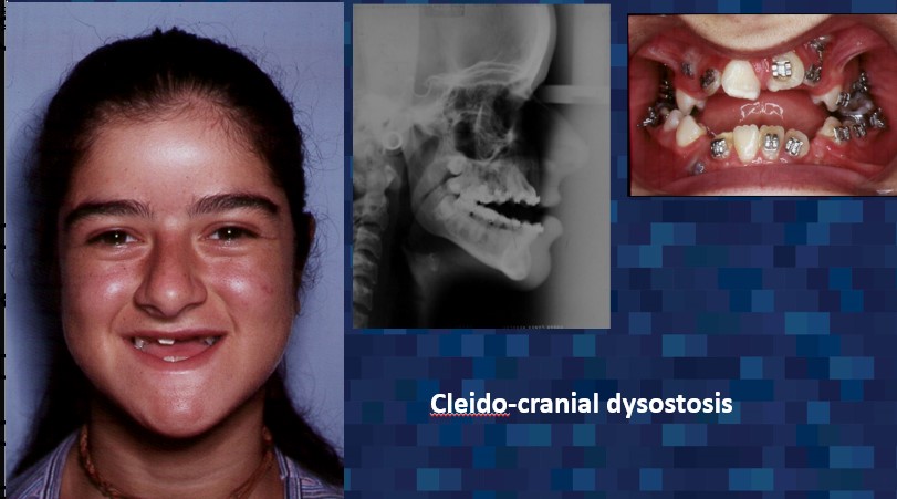 evaluation of cleido-cranial dysostosis, including front facing profile, jaw x-ray, and photo of teeth - Dr. Cesar Guerrero - Houston, TX