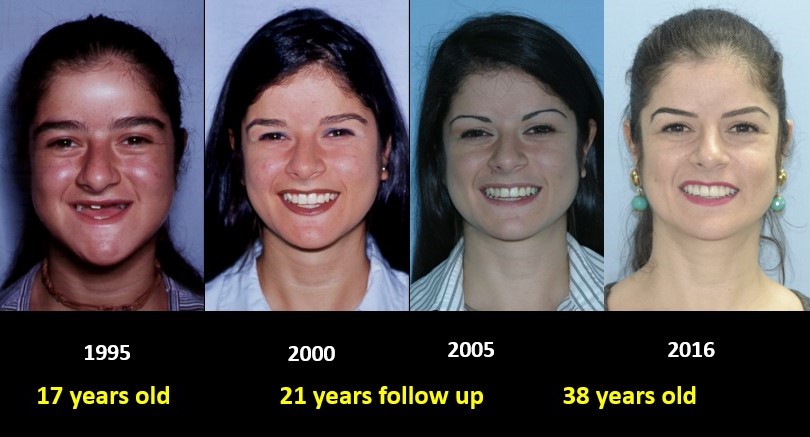 improvement of patient's cleido-cranial dysostosis shown in 21 years of follow-up
