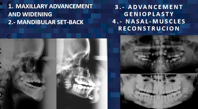 front and side profile x-rays of cleido-cranial dysostosis evaluation, surgeries involve maxillary advancement and widening, mandibular setback, advancement genioplasty, and nasal-muscles reconstruction - Dr. Cesar Guerrero