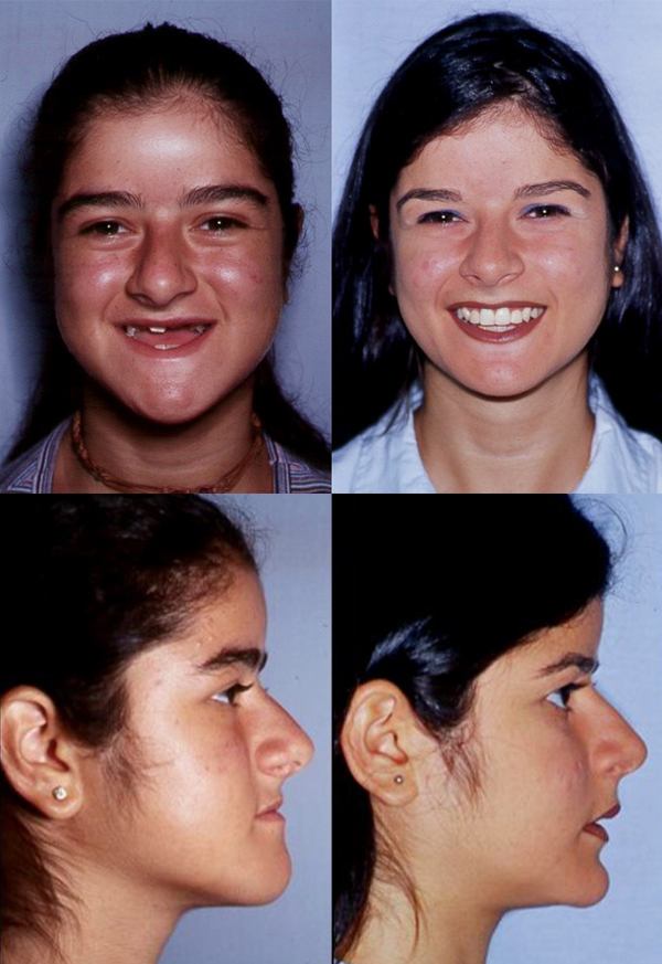 Before and after of a patient's distraction osteogenesis - Dr. Cesar Guerrero - Houston, TX