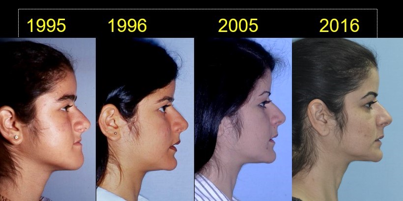 side profile improvement of patient's cleido-cranial dysostosis shown in 21 years of follow-up - Dr. Cesar Guerrero