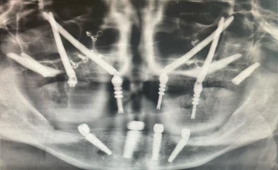 Perinasal, Pterygoid, and Zygomatic Implant X-Ray