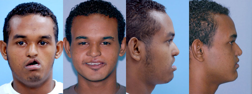 Before and after of a patient's orthognathic surgery - Dr. Cesar Guerrero - Houston, TX