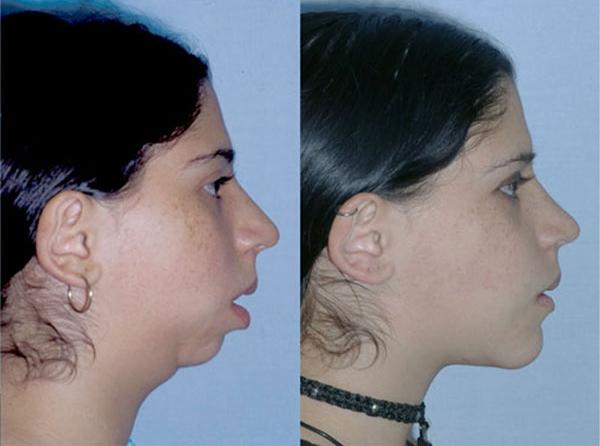 Before & After of a Pterygoid Implant