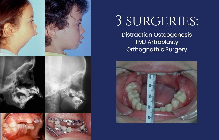 three surgeries performed on patient: distraction osteogenesis, TMJ artroplasty, and orthognatic surgery - Dr. Cesar Guerrero - Houston, TX
